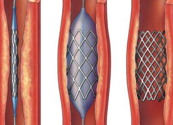 好消息！700元冠脈支架來了帶量采購(gòu)結(jié)果在甘肅省正式落地執(zhí)行